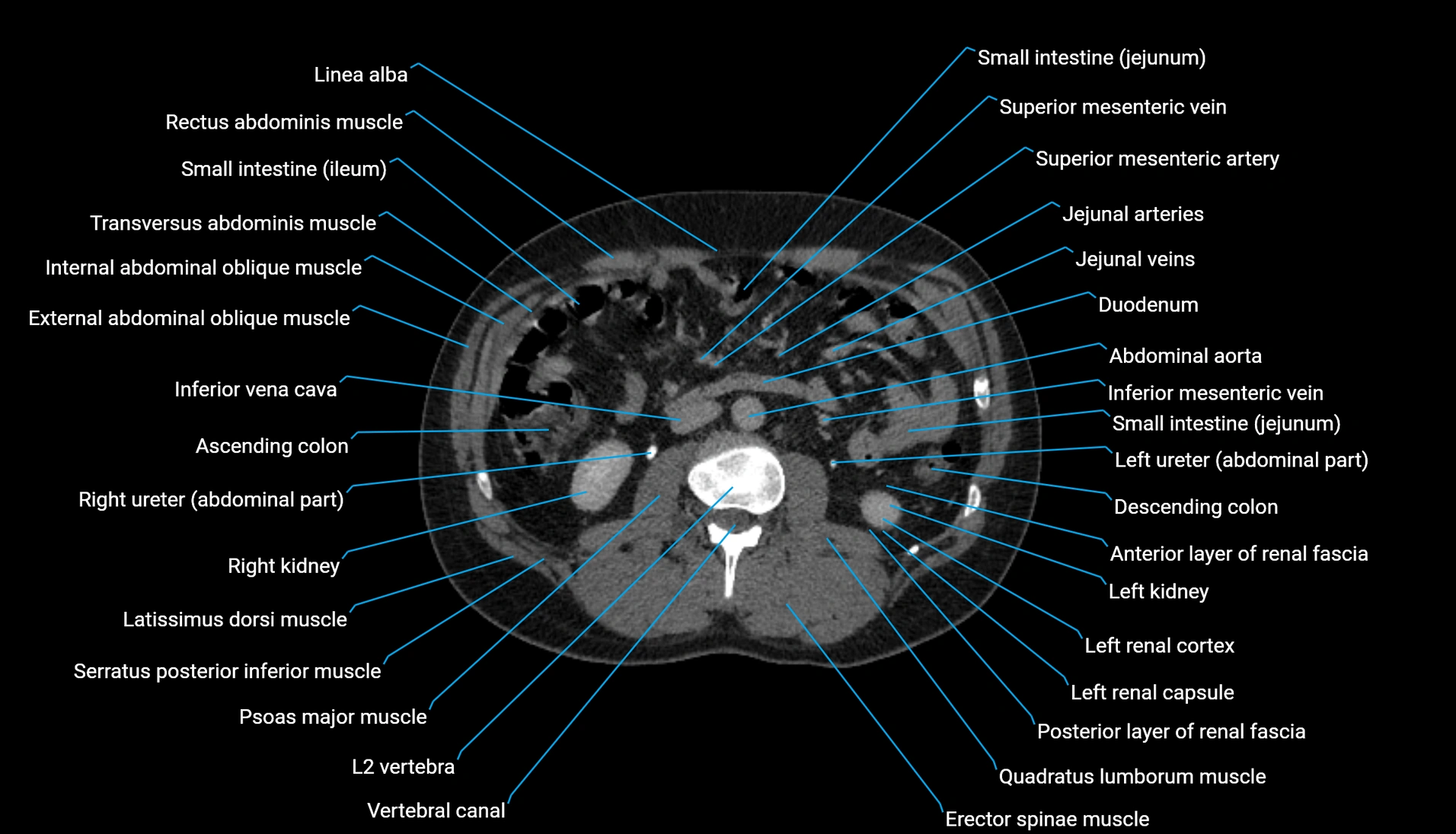 CT urogram axial cross sectional anatomy  labelled radiology image-00120.webp